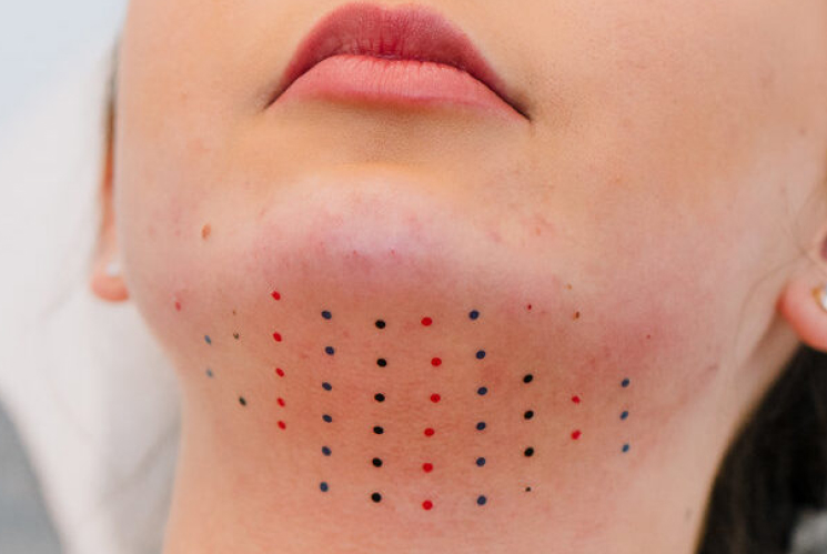 Chin marked with colored dots for a cosmetic treatment.