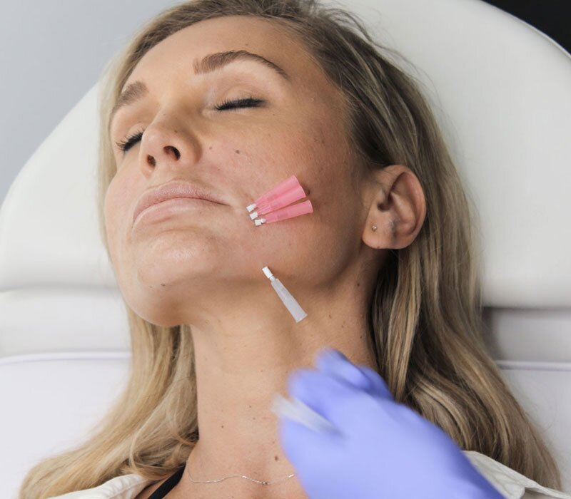 Woman undergoing a cosmetic thread lift procedure with inserted PDO threads on her lower face.